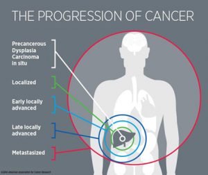 Progression of Cancer